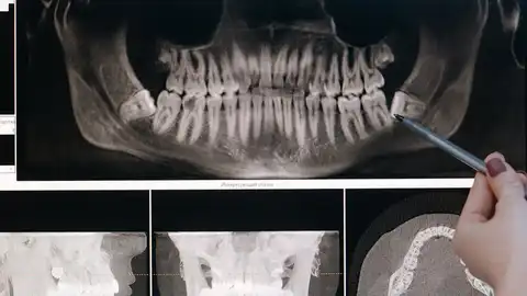 Radiografía de unos dientes Radiografía de unos dientes