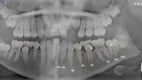 Radiografía de una dentadura Radiografía de una dentadura