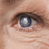 Un ojo con glaucoma Un ojo con glaucoma