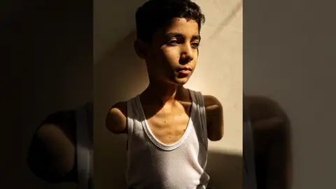 Una foto sobre secuelas de la guerra en niños gazatíes gana el World Press Photo global Una foto sobre secuelas de la guerra en niños gazatíes gana el World Press Photo global