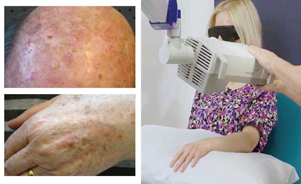 Centro Dermatológico Estético apuesta por la última tecnología contra el cáncer de piel con la Terapia Fotodinámica Centro Dermatológico Estético apuesta por la última tecnología contra el cáncer de piel con la Terapia Fotodinámica
