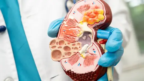 Una técnica mínimamente invasiva logra controlar la hipertensión resistente y reducir el uso de fármacos Una técnica mínimamente invasiva logra controlar la hipertensión resistente y reducir el uso de fármacos