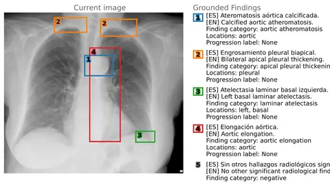 La UA impulsa un hito en IA médica con el lanzamiento del primer conjunto de datos bilingüe para radiología La UA impulsa un hito en IA médica con el lanzamiento del primer conjunto de datos bilingüe para radiología