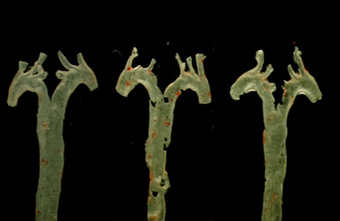 Un estudio revela el vínculo de la aterosclerosis con las bacterias del intestino: cómo se desarrolla la enfermedad y posible tratamiento Un estudio revela el vínculo de la aterosclerosis con las bacterias del intestino: cómo se desarrolla la enfermedad y posible tratamiento