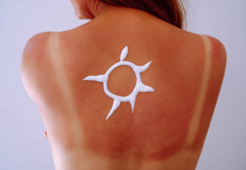 Cuidarse del sol no es exagerar, es prevenir. Desde el MUDIC alertan de la importancia de proteger nuestra piel de los rayos solares Cuidarse del sol no es exagerar, es prevenir. Desde el MUDIC alertan de la importancia de proteger nuestra piel de los rayos solares