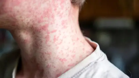 Archivo - Imagen de un enfermo con sarampión. - JUNTA DE ANDALUCÍA - Archivo Archivo - Imagen de un enfermo con sarampión. - JUNTA DE ANDALUCÍA - Archivo