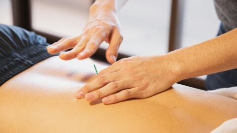 Acupuntura