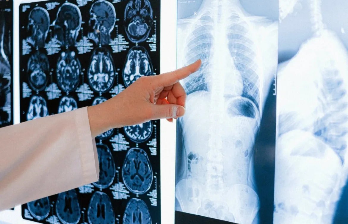 Radiografía de cáncer de pulmón Radiografía de cáncer de pulmón