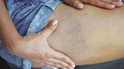 Médicos de Vithas alertan en la Comunidad Valenciana sobre el incremento de trastornos venosos y su impacto en la salud Médicos de Vithas alertan en la Comunidad Valenciana sobre el incremento de trastornos venosos y su impacto en la salud