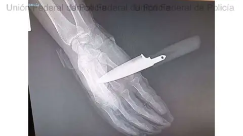 Radiografía de la mano del agente de la Policía Nacional apuñalado en Baza Radiografía de la mano del agente de la Policía Nacional apuñalado en Baza