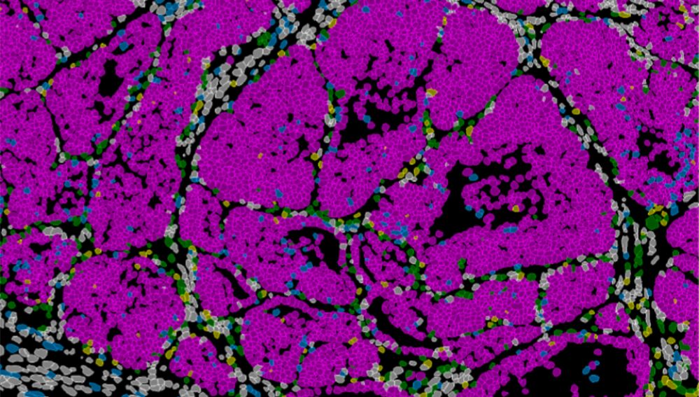 Imagen de un tumor de mama en ratón que muestra las distintas poblaciones celulares (células cancerosas en rosa). 