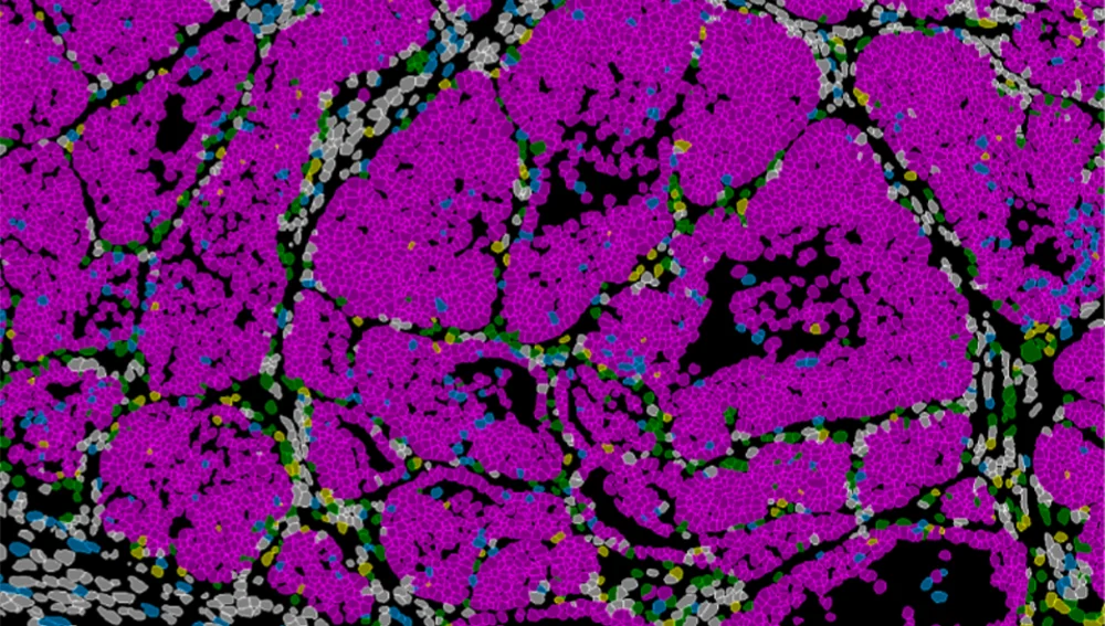 Imagen de un tumor de mama en ratón que muestra las distintas poblaciones celulares (células cancerosas en rosa). Imagen de un tumor de mama en ratón que muestra las distintas poblaciones celulares (células cancerosas en rosa).