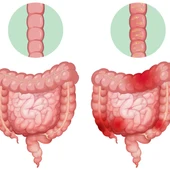 Recreación de los intestinos de una persona Recreación de los intestinos de una persona