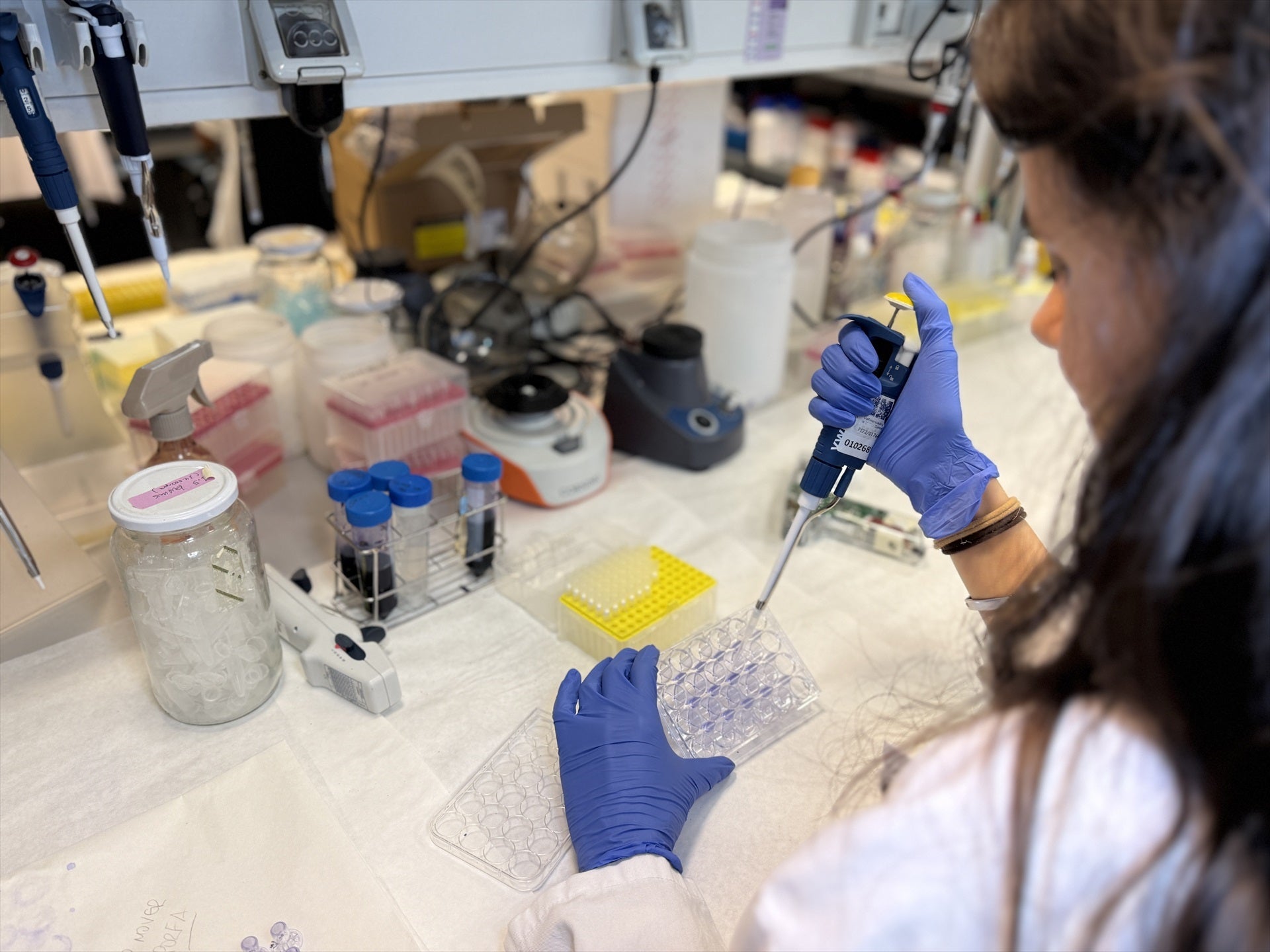 Investigadores del Hospital La Paz identifican una proteína que explica la elevada agresividad del melanoma. Investigadores del Hospital La Paz identifican una proteína que explica la elevada agresividad del melanoma.