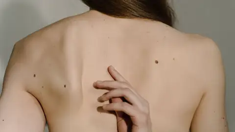 Así funciona la nueva vacuna de ARNm contra el melanoma que abre una vía para tratar otros cánceres Así funciona la nueva vacuna de ARNm contra el melanoma que abre una vía para tratar otros cánceres
