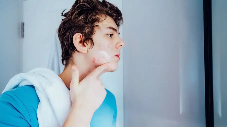 Acne Acne