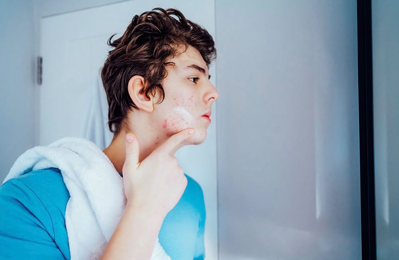 La vuelta al cole también se nota en la piel: el estrés puede empeorar el acné en los adolescentes La vuelta al cole también se nota en la piel: el estrés puede empeorar el acné en los adolescentes
