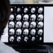 Cerca de 15.630 personas padecen alzhéimer en Granada: los hospitales avanzan en diagnósticos más precisos Cerca de 15.630 personas padecen alzhéimer en Granada: los hospitales avanzan en diagnósticos más precisos