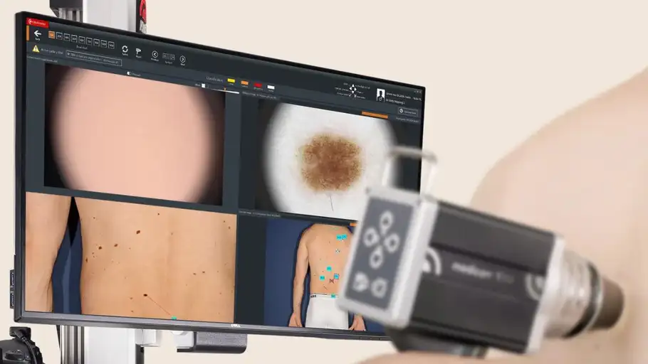 Melanoma Melanoma