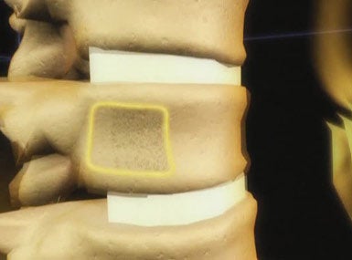 Seguir el tratamiento de la osteoporosis reduce hasta un 70 % el riesgo de fractura Seguir el tratamiento de la osteoporosis reduce hasta un 70 % el riesgo de fractura