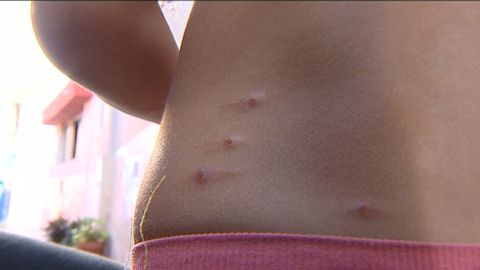 Plaga de pulgas en Santa Cruz