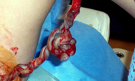 La sangre del cordón umbilical podrá tratar enfermedades autoinmunes como la diabetes, la esclerosis o el lupus La sangre del cordón umbilical podrá tratar enfermedades autoinmunes como la diabetes, la esclerosis o el lupus