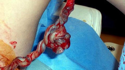 Cord&oacute;n umbilical