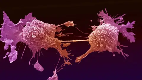 Células de cáncer de pulmón Células de cáncer de pulmón