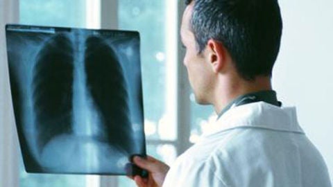 Progresos m&eacute;dicos para combatir el c&aacute;ncer de pulm&oacute;n 