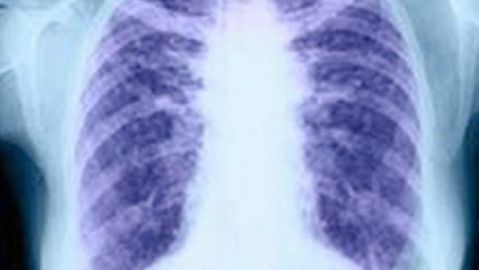 El c&aacute;ncer de pulm&oacute;n 