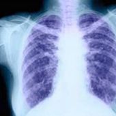 El cáncer de pulmón 