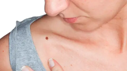 Un 23,5% de los españoles, de más de 45 años, tiene manchas solares en la piel Un 23,5% de los españoles, de más de 45 años, tiene manchas solares en la piel