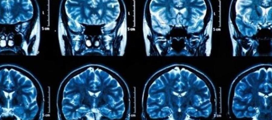 Tumores cerebrales Tumores cerebrales