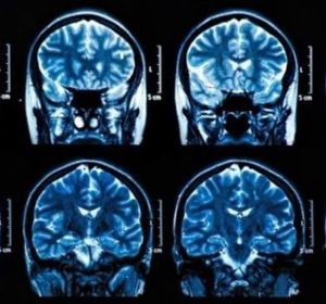 Tumores cerebrales Tumores cerebrales