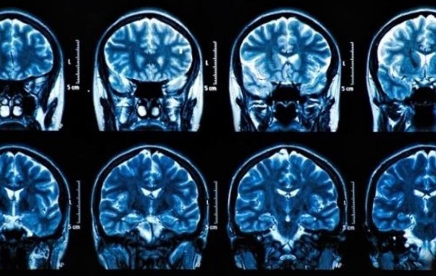 <p>Una nueva terapia logra reducir la metástasis cerebral en el 75% de los pacientes</p> <p>Una nueva terapia logra reducir la metástasis cerebral en el 75% de los pacientes</p>
