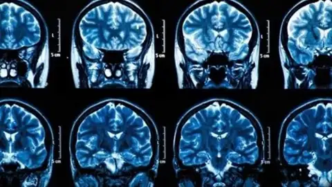 Tumores cerebrales Tumores cerebrales