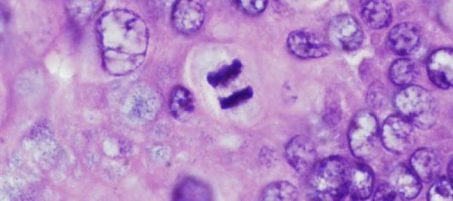 Investigan la mutación BRCA1 y BRCA2 en cáncer de ovario y mama Investigan la mutación BRCA1 y BRCA2 en cáncer de ovario y mama