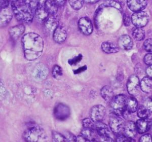 Investigan la mutación BRCA1 y BRCA2 en cáncer de ovario y mama Investigan la mutación BRCA1 y BRCA2 en cáncer de ovario y mama
