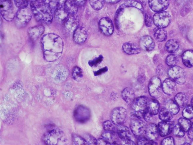 Un nuevo tratamiento logra prolongar la supervivencia en pacientes con cáncer de ovario avanzado Un nuevo tratamiento logra prolongar la supervivencia en pacientes con cáncer de ovario avanzado