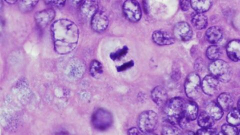 Investigan la mutaci&oacute;n BRCA1 y BRCA2 en c&aacute;ncer de ovario y mama