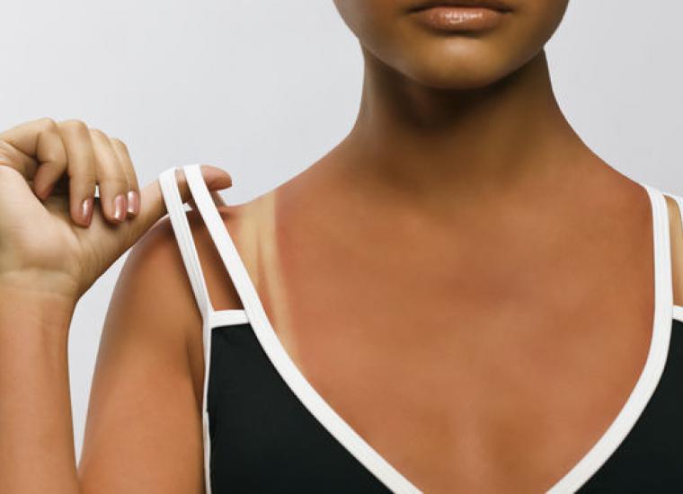 Tanorexia, obsesión por el sol Tanorexia, obsesión por el sol