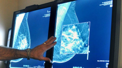 Un test al diagnosticar el c&aacute;ncer de mama predice c&oacute;mo ir&aacute; el tratamiento