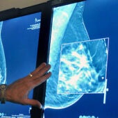 Un test al diagnosticar el cáncer de mama predice cómo irá el tratamiento