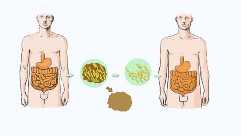 na nueva t&eacute;cnica podr&iacute;a mejorar el trasplante de microbiota intestinal 
