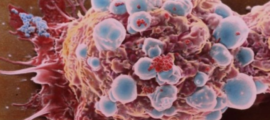 Célula cancerosa de cáncer de mama Célula cancerosa de cáncer de mama