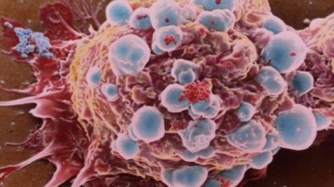 C&eacute;lula cancerosa de c&aacute;ncer de mama