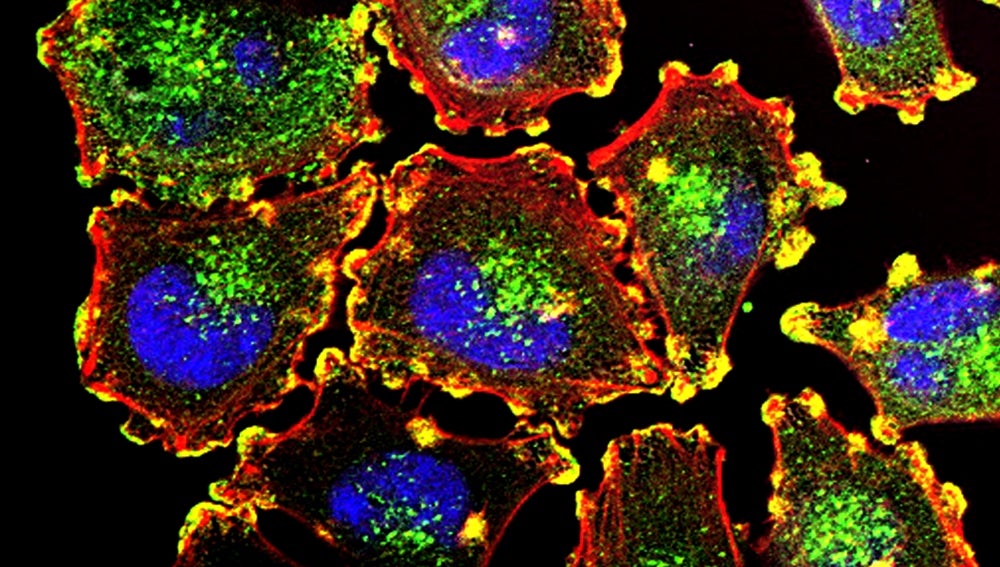 Descubren movimientos celulares que ayudarán a comprender el proceso de metástasis Descubren movimientos celulares que ayudarán a comprender el proceso de metástasis