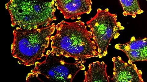 Imagen de c&eacute;lulas cancerosas