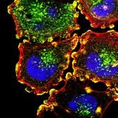 Imagen de células cancerosas