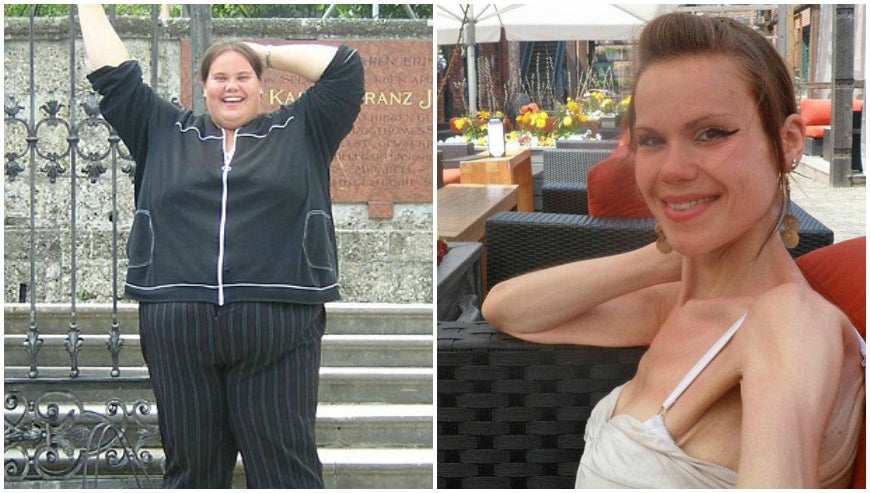 Una mujer pasa de la obesidad mórbida a la anorexia por su obsesión con el peso Una mujer pasa de la obesidad mórbida a la anorexia por su obsesión con el peso
